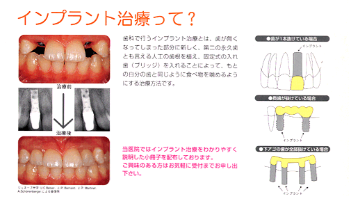 �C���v�����g���Â���?